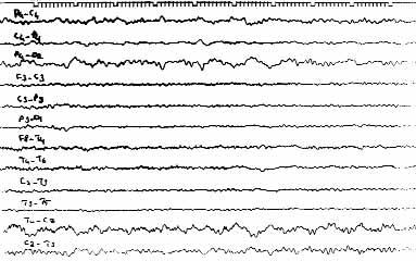 Taflç lar ve ark. Yafll epilepsi hastalar nda elektroensefalografinin tan de eri 35 lit, bir menenjit, bir ensefalomyelonörit) saptand. Nöbetlerin 10 hastada (%6.