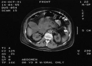 TANI Radyoloji-Abdominal CT Şiddetli pankraetit Tanı şüpheli ise (ACG Strong recommendation, Low quality of evidence) 87% 90% sensitivity and 90% 92% specificity