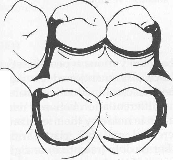 MULTIPLE KROŞE Multiple kroşe iki respirokal kolun terminal sonunda birleşen karşılıklı iki çevresel kroşeden oluşur. Diş destekli bölümlü protezlerde ilave tutuculuk istenildiğinde düşünülebilir.