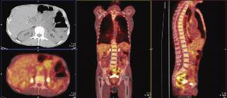 Ali Zahit BOLAMAN MULTIPL MYELOM TANISI VE TEDAVİYE YANIT KRİTERLERİ RESİM : 6 yaşında pankreas kanseri tanılı tedavi almamış erkek hasta. SUVKİT,.; SUVKİL,.; SUVKC,.8; TOT,.; TOL,.