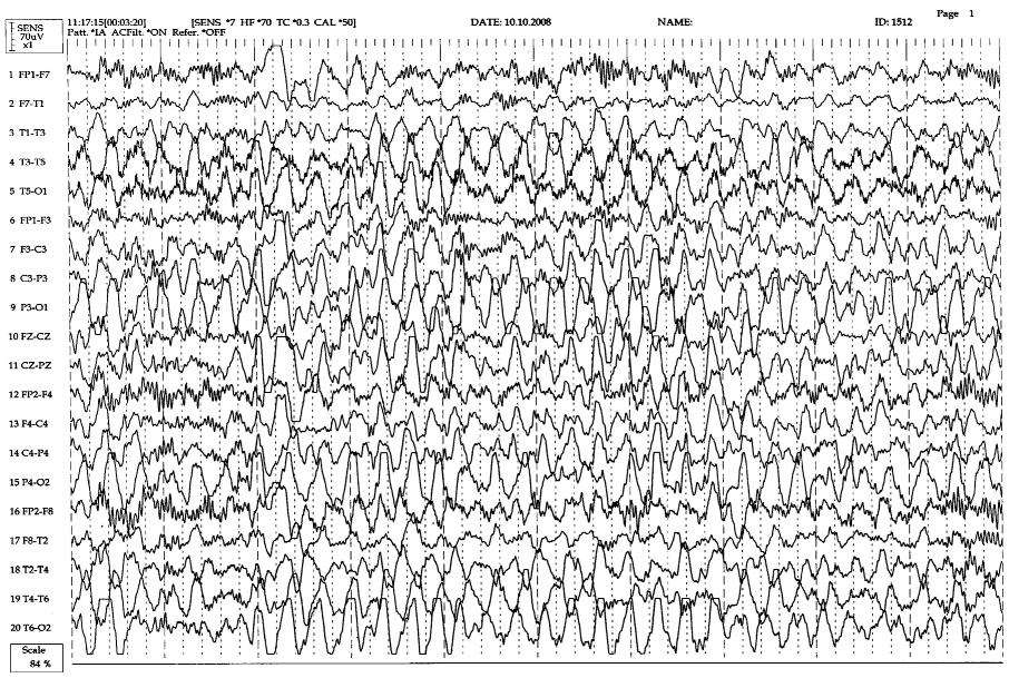 Lafora Hastalığı Biçer Gömceli Y, Erdal A, Kutlu G, İnan LE. Resim 2. Olgu 2 ye ait, oksipital bölgelerde daha büyük amplitüdlü diken ve çoklu diken dalgalar n izlendi i EEG trasesi.