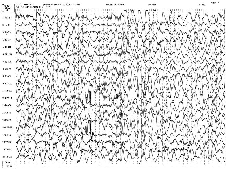 Biçer Gömceli Y, Erdal A, Kutlu G, İnan LE. Lafora Disease Resim 3. Olgu 1 e ait koltuk alt ter bezi biyopsisinde intrasitoplazmik PAS(+) inklüzyonlar. Resim 4.