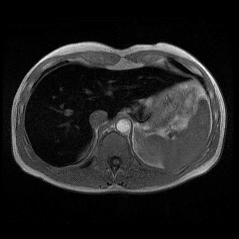 BT de KC dansitesinde artış meydana gelir ( >72HU) (Ancak Steatoz zemininde yapılan ölçümler şüpheli) MR Hemokromatosis tanı ve takibinde