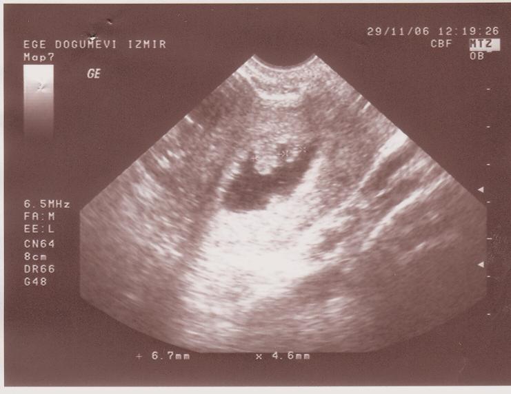 Bulgular Endometrial kavitenin de erlendirilmesi Duyarl l k Özgüllük PPV NPV % 87.8 % 100 % 100 % 95.4 di (Resim 6). Hiç bir hastada uterin anomali saptanmad. Resim 4.