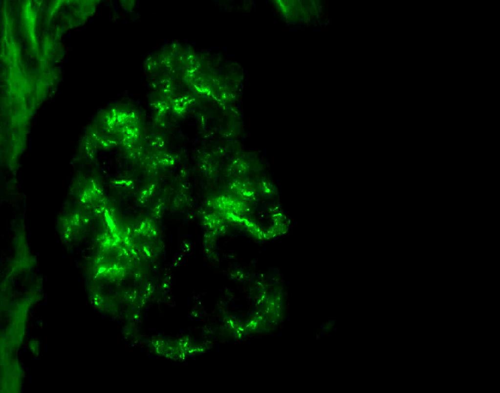 İmmünfloresan mikroskopi: IgA +++, C3+++, IgG+ mezangial