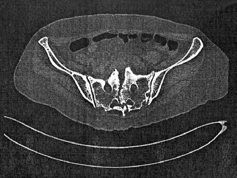 Preoperatif BT; Santral