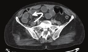 Peritoneal veya mezenterik açıklıklar konjenital olabileceği gibi inflamasyon, travma veya geçirilmiş cerrahiye bağlı olabilir.