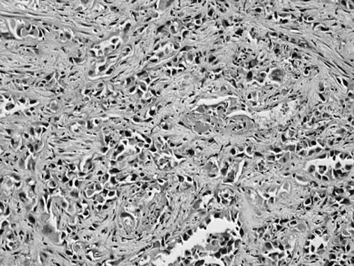 Şekil 1. Az diferansiye skuamöz hücreli karsinomda tek hücre keratinizasyonları izleniyor.
