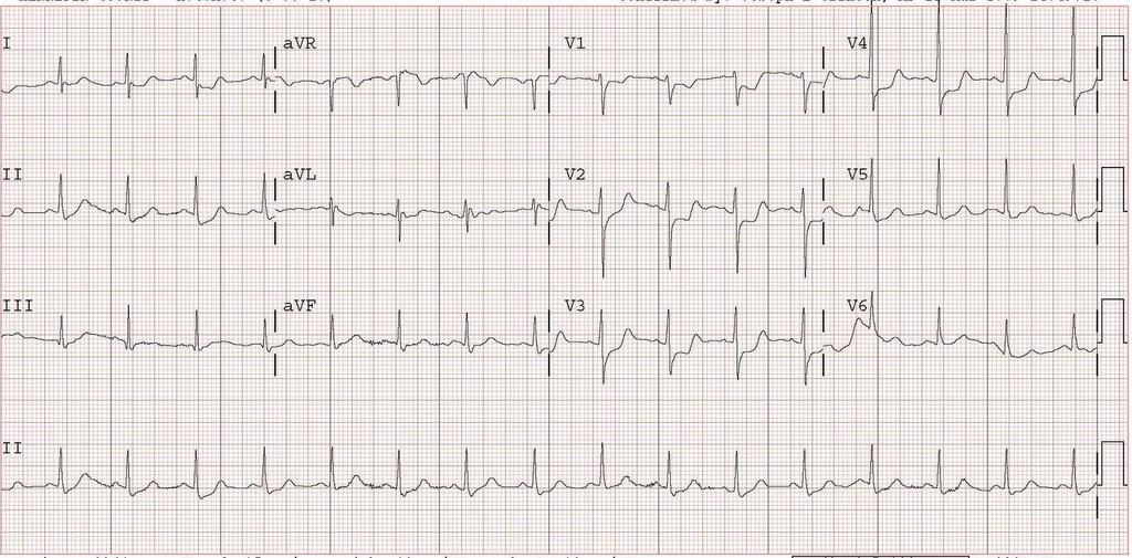 EKG