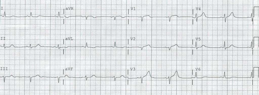 EKG 19:13