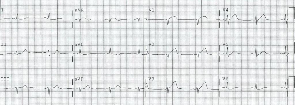 EKG 19:20