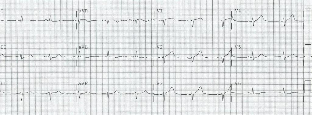 EKG 19:26