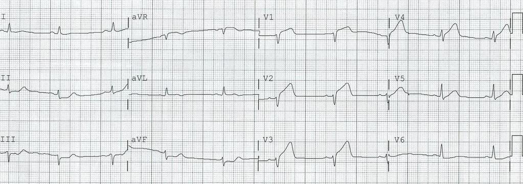 EKG 19:44