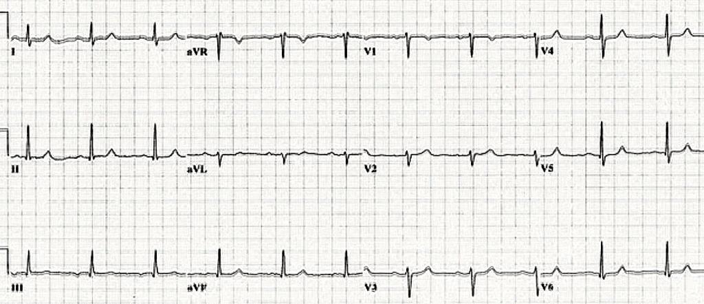 V1 de yeni yüksek T dalgası (prekordiyal T dalga dengesinin kaybolması) Normal EKG de V1 in T dalgası