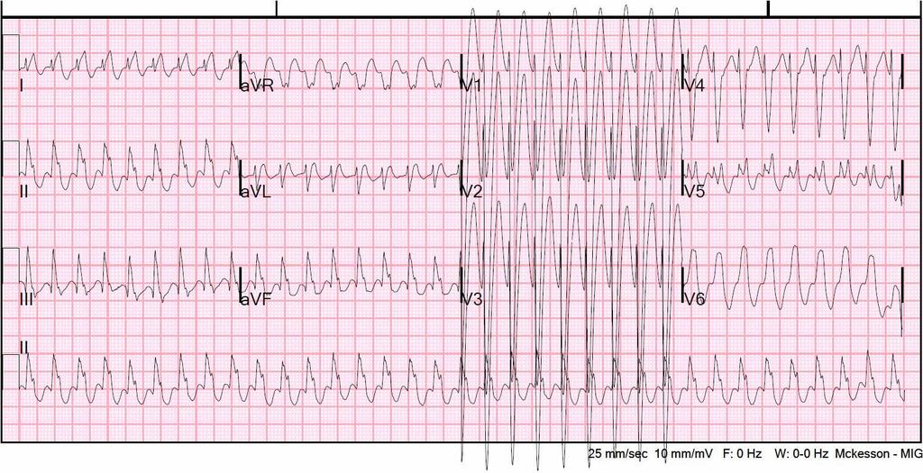 EKG