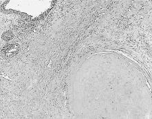 Overde matür kistik teratom içinde yer alan k k rdak dokusu ve respiratuvar epitel (HE x40). Resim 3. Matür kistik teratom içinde geliflen insüler karsinoid tümör (HE x40).