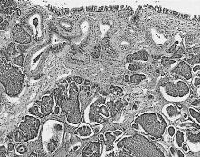 Özellikle insüler karsinoid; overin solid teratomu, müsinöz tümörleri (2), sertoli leydig hücreli tümörleri (10) ile birlikte görülebilir.