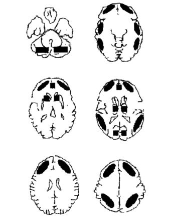 S. Ebrinç, C. Baflo lu, V. Y lmaz, M. Çetin, Y. Narin, M. Y. A argün Cerebellum Inf.Front.2 BULGULAR Caudate Sup.Front.1 Cingulate Cingulate Occipital Inf.Front.1 Thalamus Ant. Temp. Post. Temp.1 Inf.