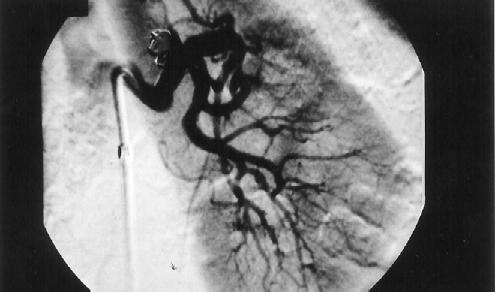 Anevrizma öncesi ve sonras ndaki darl klara geniflleyebilir stent uygulamas ve mikrokoillerle anevrizman n embolizasyonu. Resim 3.