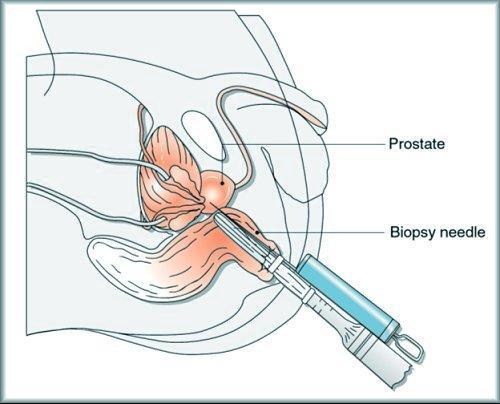 Prostat İğne