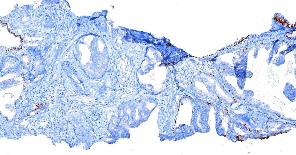 tpsa:26ng/ml TRUS