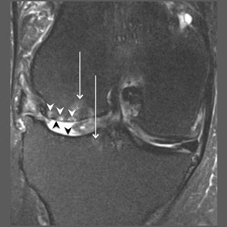 Neoplazik Olmayan Kemik İliği ozuklukları 549 ödemi ve ciltte kalınlaşma görülür (Resim 9, C). kut evrede eklemde efüzyon ve sinovyal kalınlaşma saptanabilir [3, 11]. 4.