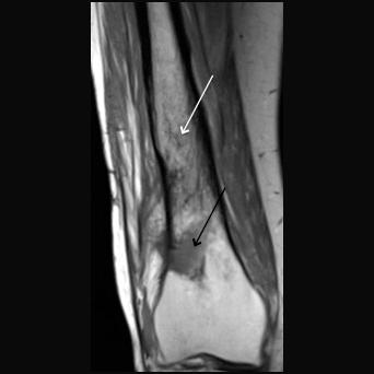 Lezyon periferal kontrastlanmakta olup, lezyon periferindeki sklerotik halka tüm sekanslarda hipointens izlenir. Kronik Osteomyelit Resim 11. -C. Femurda akut osteomiyelit.