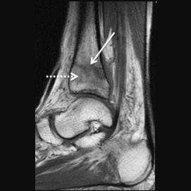 542 Tokgöz N. Resim 2.,. kut travma sonrası tibiada kırık. Sagittal T1 () ve STIR () sekanslarda; tibia distal metafizinde intramedüller hipointens kırık hattı izleniyor (oklar).