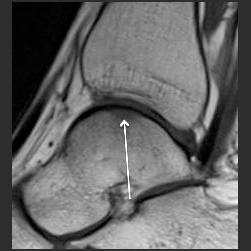 Sagittal T1 (), talus medyal kubbesinde fokal hipointens lezyon (ok); sagittal STIR (), eşlik eden belirgin medüller ödem (kesintili ok); üç boyutlu GRE (DESS) (C); keskin kontur özelliği ve kıkırdak