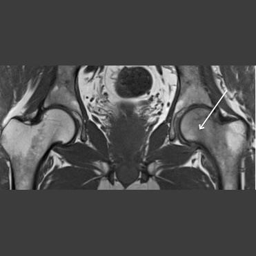 13 ay sonra karşı tarafta ağrı ortaya çıkan hastada koronal STIR da (C); sağ femur başında kemik iliği ödemi (kesintili ok) izleniyor ve gezici osteoporoz tanısı alıyor.