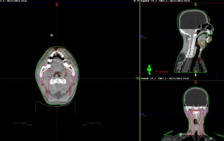 CBCT GÖRÜNTÜSÜ Hastanın CBCT görüntüsü planlama CT si ile eşleştirilmiş, kafa tabanı ve