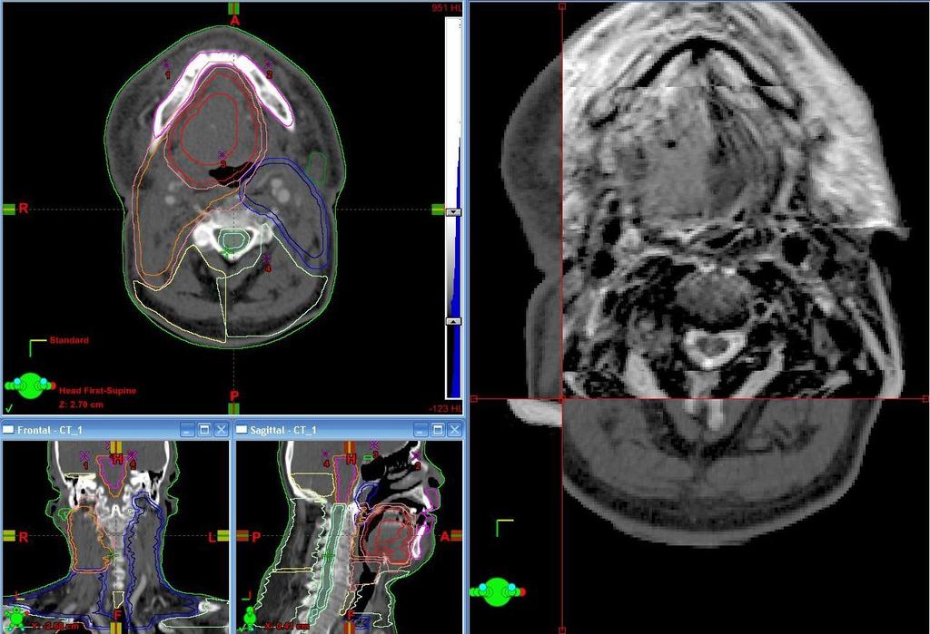 MRI JK