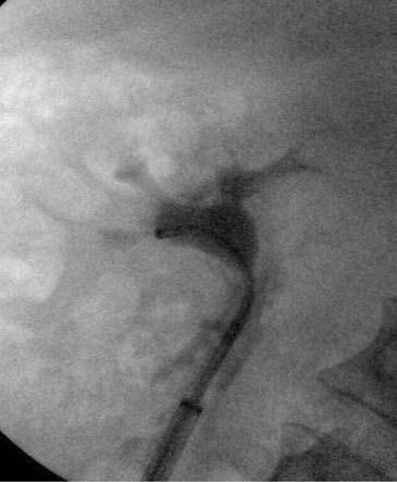 110 Türk Üroloji Dergisi - Turkish Journal of Urology 2009;35(2):108-112 Şekil 2 20 mm büyüklüğünde alt kalis taşının retrograd intrarenal cerrahi ile erişim kılıfı kullanılarak tedavisi.