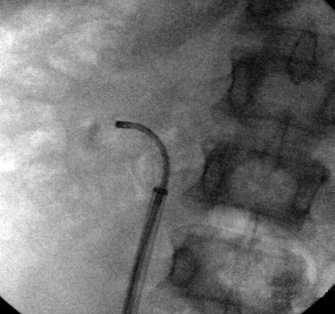 Bu hastaların üçünde ameliyat sonrası 4-6. haftada JJ kateterin çıkarılması sırasında f-urs ile bu parçalar da çıkarıldı. Sonuçta, radyolojik kontrollerde taşsızlık oranı USG ve DÜSG ile %90.