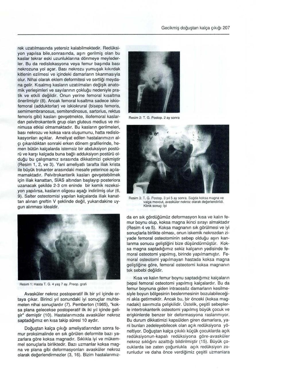 Gecikmiş doğuştan kalça çıkığı 207 rek uzatılmasında yetersiz kalabilmektedir. Redüksiyon yapılsa bile,sonrasında, aşırı gerilmiş olan bu kaslar tekrar eski uzunluklarına dönmeye meylederler.