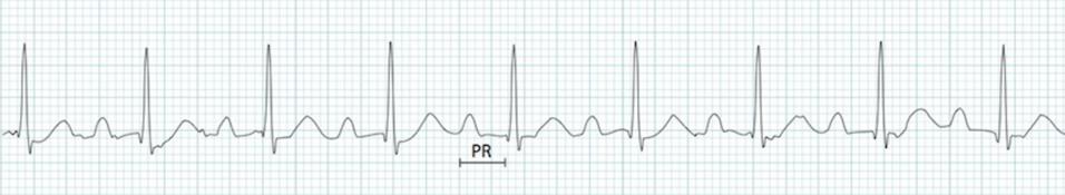 1. Derece AV Blok PR >0.