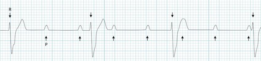 3. Derece AV (Tam) Blok AV nodda ileti hiç yok, atriyumlar ve ventriküller birbirinden bağımsız P dalgaları kendi aralarında, QRS ler kendi