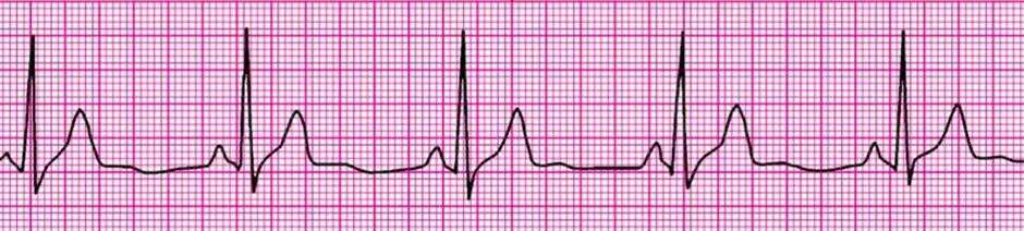 Sinüs Bradikardisi Ritim düzenli (Her P yi QRS