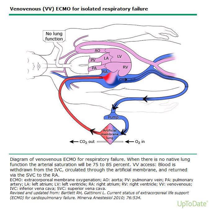 YBÜ-destek tedavisi ECMO Sağ ventrikül yükü alınır Pulmoner