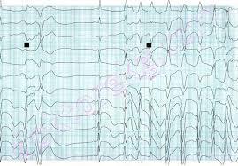 EKG İdioventriküler ritimler Ventriküler ekstrasistoller Ventriküler