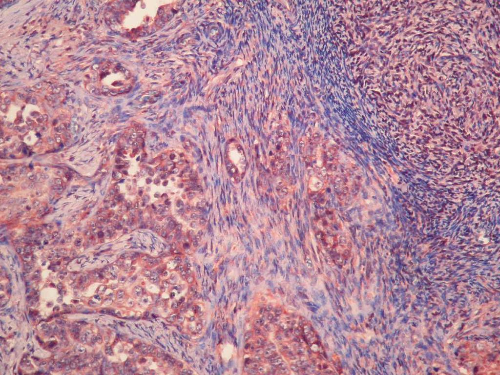 Şekil 17. BRCA2 (Novus) ile normal over dokusunda % 50 nin üzerinde nükleer pozitif boyanma görülürken tümöral dokuda nükleer boyanmanın % 50 nin altında izlendiği over seröz adenokarsinoma olgusu.