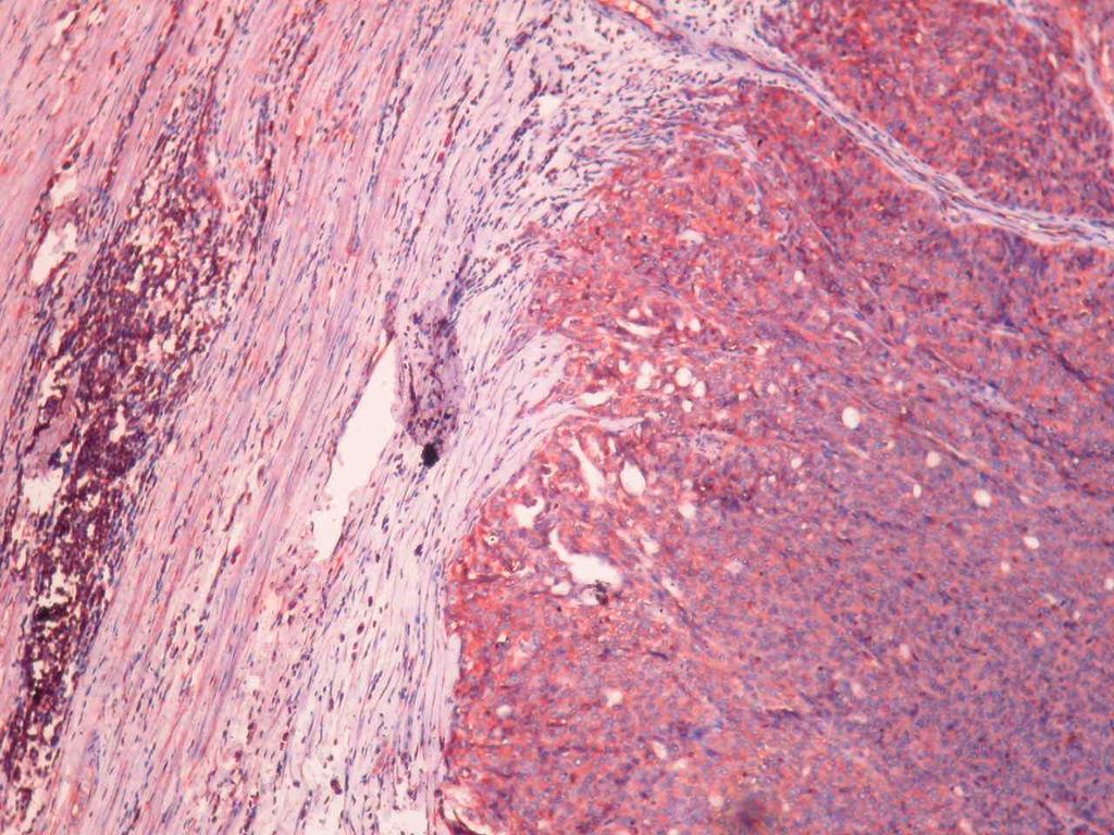 Şekil 22. BRCA2 (Novus) ile negatif nükleer boyanma gösteren başka bir fallop tüpü karsinomu olgusu.