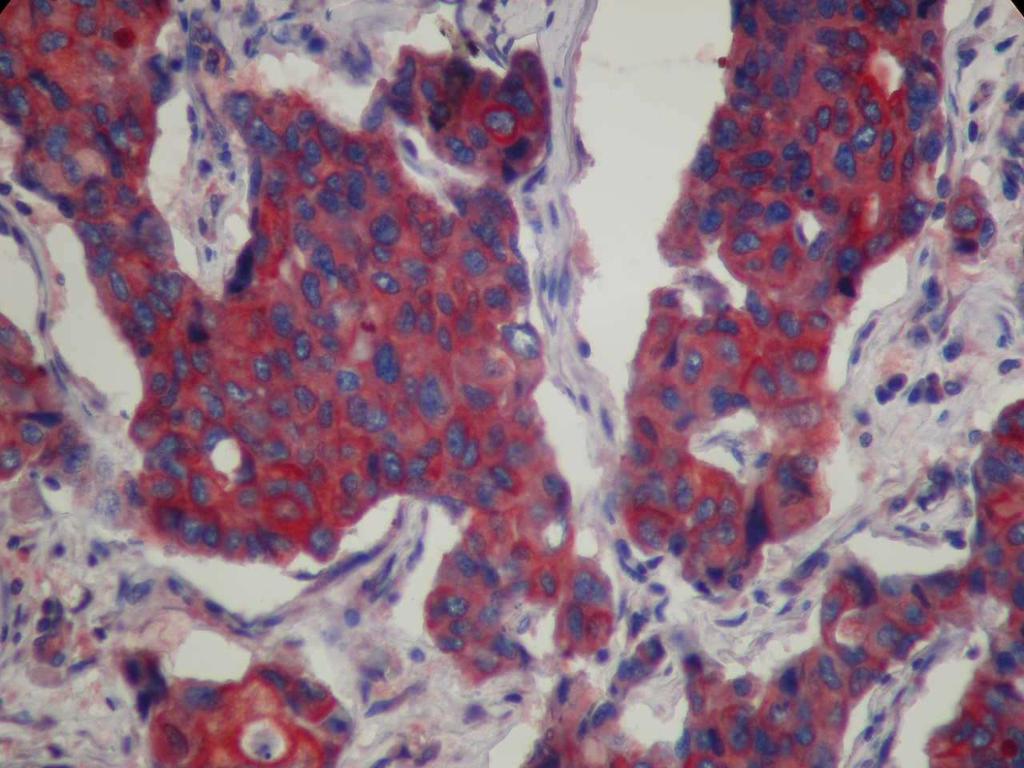 Şekil 26. Grade II meme karsinomu olgusunda BRCA1(DakoCytomation) ile orta şiddette (++) sitoplazmik boyanma Şekil 27.