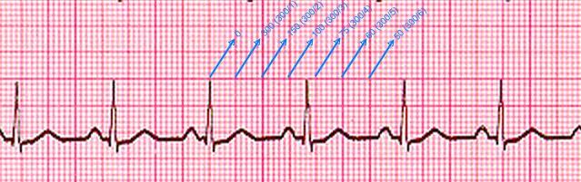 2 1.2.1 Kalp ritmi düzenli olan hastada, kalp hızının hesaplanması; a) R-R dalgaları arasındaki büyük ve küçük kareler vasıtasıyla hızın hesaplanması; İki R-R dalgası, yani iki ventriküler