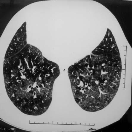 Sol akciğerdeki bronşların komşuluğundaki pulmoner arterlerden daha küçük olduğuna dikkat ediniz. Resim 4.