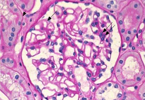 Şekil 5 Normal Glomerül ve IgA Nefropatisinde görülebilen patolojik bulgular* Normal Glomerül: (Işık Mikroskopisi) Her kapiller öbekte bir veya iki hücre mevcut ve kapiller lümenler açık.
