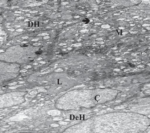 Mitokondriyonlarda belirgin ödem ve kristolizis izlendi.