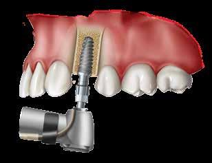 CERRAHİ PROTOKOL Adım 2: Başlangıç Yerleştirmesi Uygun İmplant Sürücüyü yerleştirirken, implantın oklüzal ucunu tutucuya sıkıştırmak için parmağınızla hafifçe bastırın.