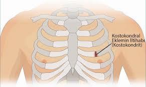 Kostokondrit ÜSYE ve egzersizden sonra ortaya çıkar Ağrının yeri 2.-6.