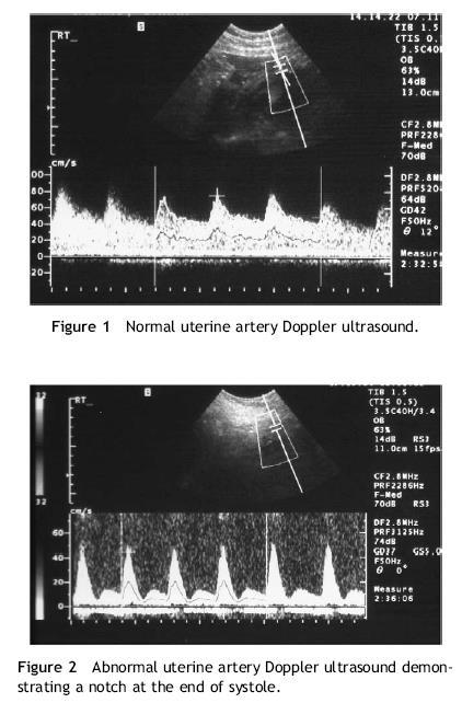 Uterin arter dopler UtA akımlarında üç tip patoloji 1-Yüksek vasküler direnç S-D/S=RI > 95.per S-D/TAMX=ortalama mak.akım hızı=pi >95.per 24 hf sonra S/D >2.